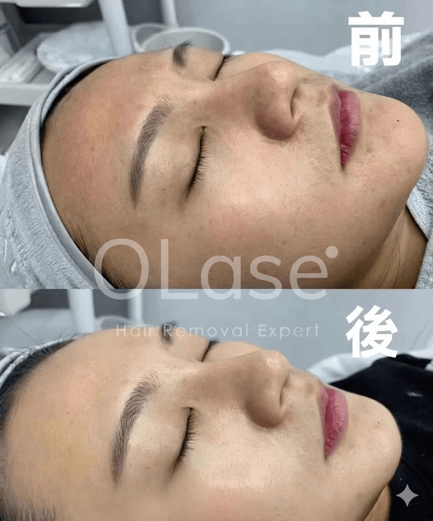 Cell Light II 細胞光治療前後對比案例 2