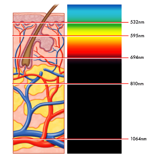 GentleLase 激光脫毛運作原理示意圖