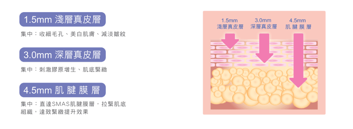 HIFU 聚焦超聲波療程前後效果比較圖