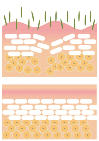陶瓷肌煥膚術治療示意圖