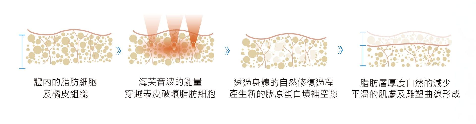 ULTRAFORMER 緊實作用原理示意圖