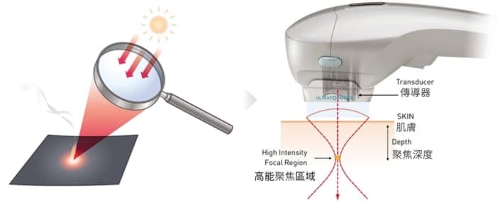 HIFU 聚焦超聲波作用原理示意圖