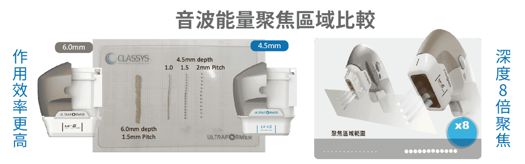 ULTRAFORMER 雙下巴探頭緊實作用原理示意圖