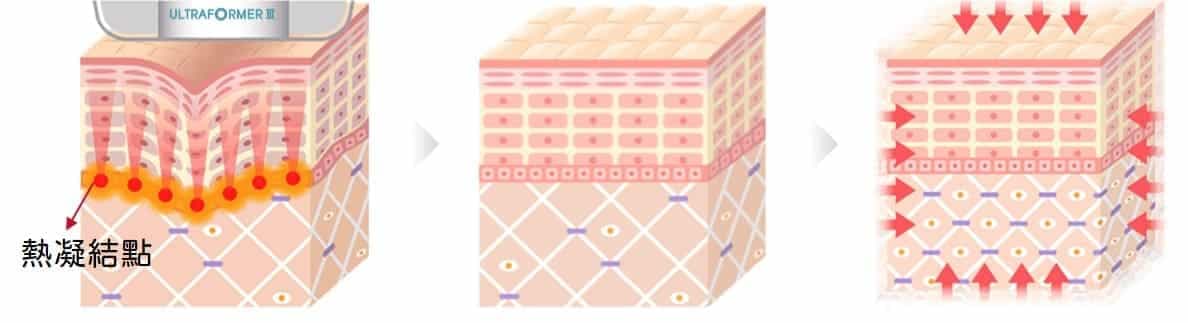 ULTRAFORMER III 深層緊實作用原理示意圖
