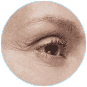 ULTRAFORMER 適用部位：細紋