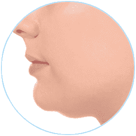 ULTRAFORMER 適用部位：雙下巴