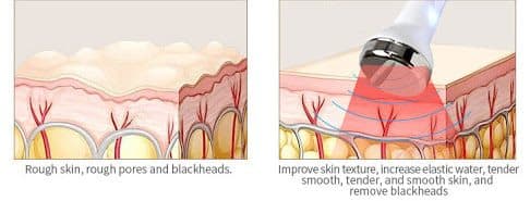 Aqua Peel 深層清潔護理步驟示意圖二