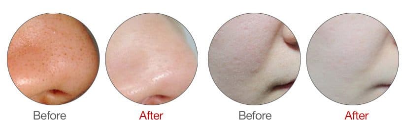 Aqua Peel 暗瘡改善前後對比圖一