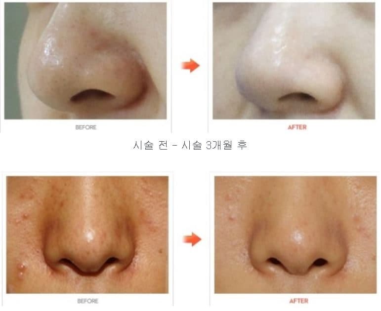 Aqua Peel 粉刺及黑頭改善前後對比圖