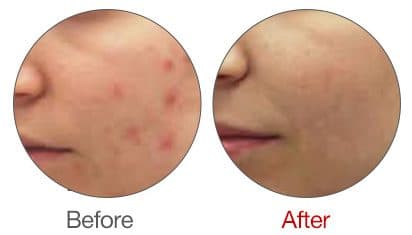 Aqua Peel 毛孔粗大改善對比圖