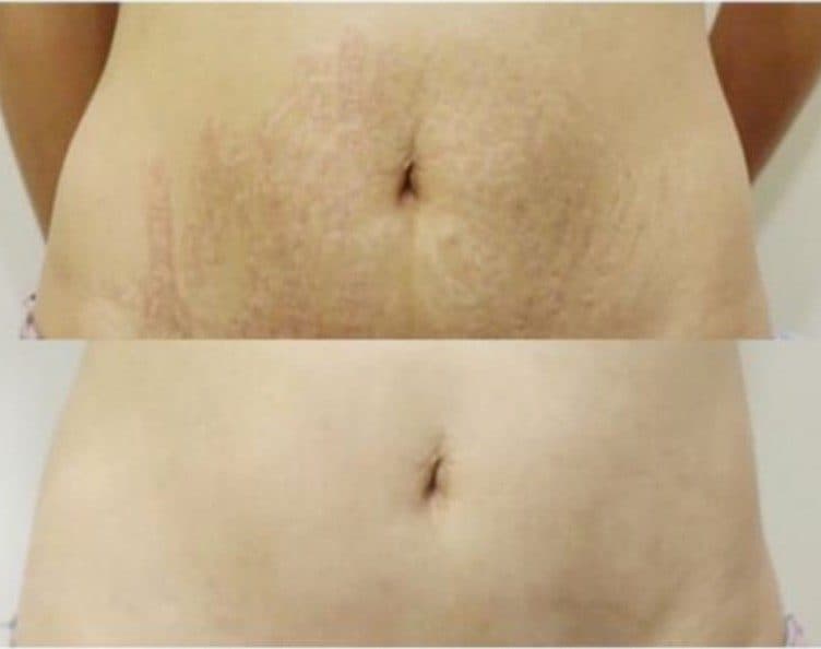 CO2飛梭雷射針對痘疤、凹凸洞及毛孔粗大療程前後對比圖