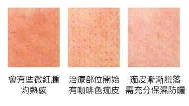 CO2飛梭雷射針對痘疤及暗瘡皮膚療程前後對比圖