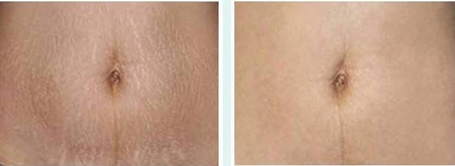 CO2飛梭雷射針對肚紋與妊娠紋療程前後對比圖