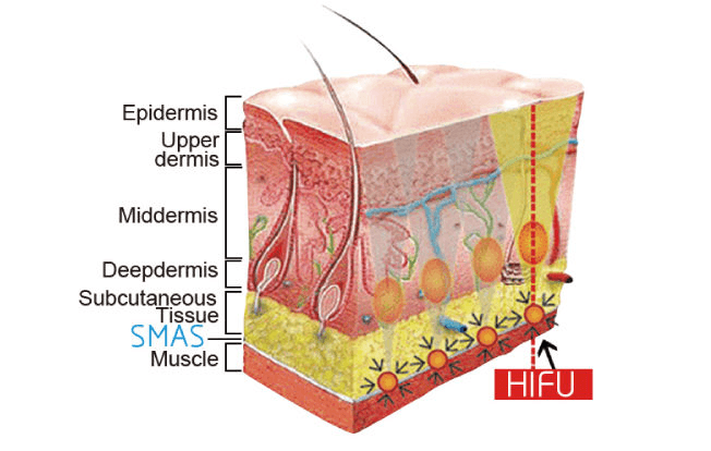 Liftera V Lift 無針埋線儀器示意圖