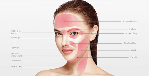 無針埋線 Ultra V Lift、Liftera V Lift 與 HIFU 療程效果比較圖