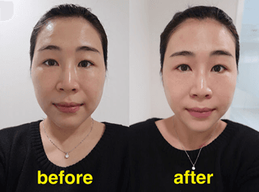 Liftera V Lift 療程效果前對比圖