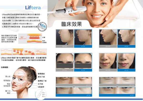 Liftera V Lift 無針埋線療程流程與原理介紹圖