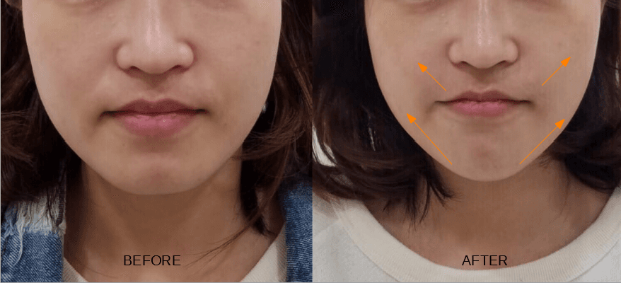 Liftera V Lift 療程效果後對比圖