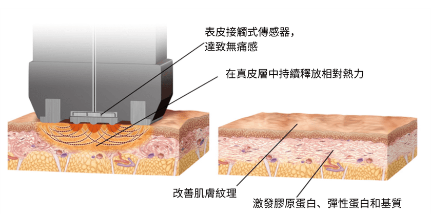 InMode A.C.E. 恒溫熱能膠原增生技術示意圖