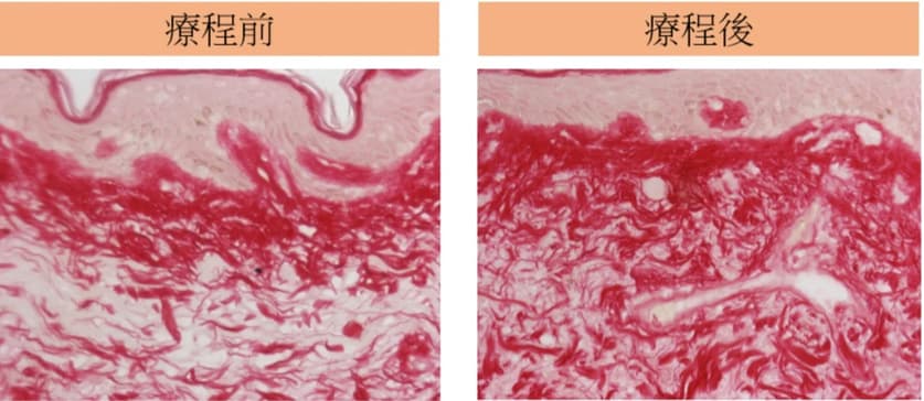 InMode HVP 高壓細胞膜爆脂技術示意圖