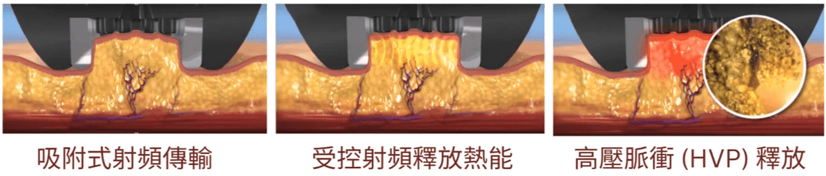 InMode 鑽石超塑作用原理圖一