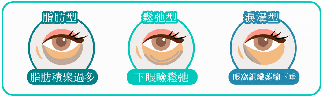 不同類型眼袋示意圖