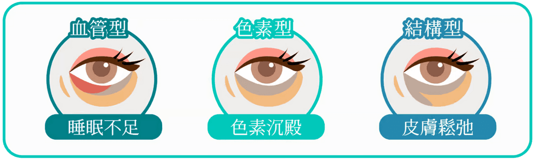 不同類型黑眼圈示意圖
