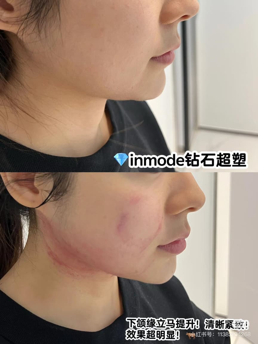 InMode 鑽石超塑術後護理示意圖一