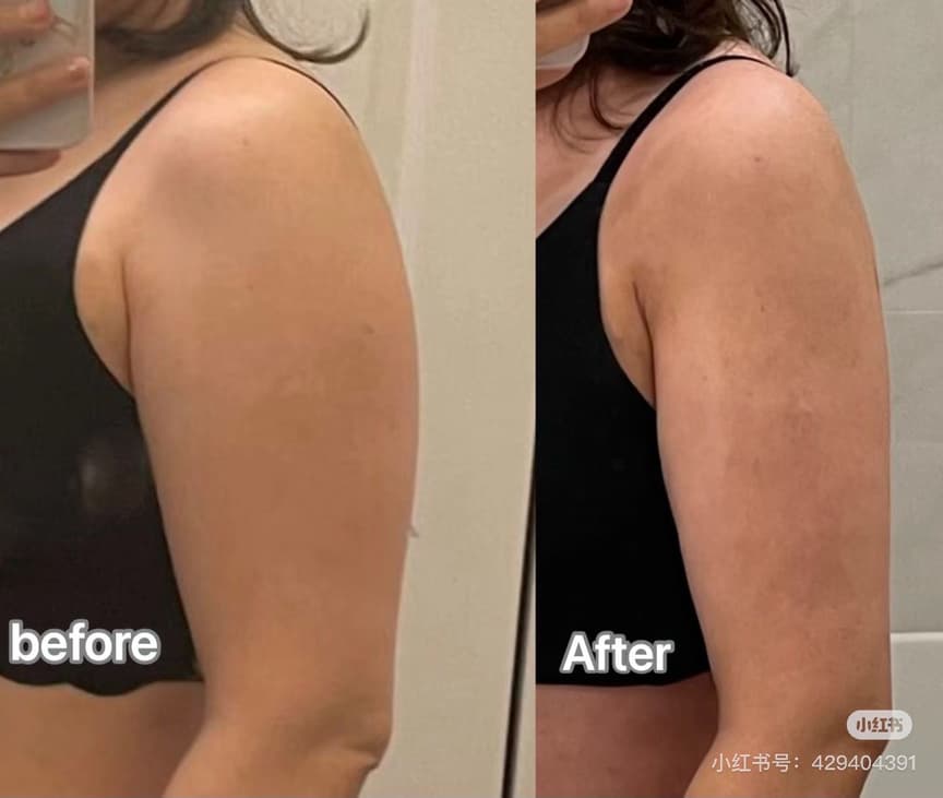 InMode 鑽石超塑術後護理示意圖二