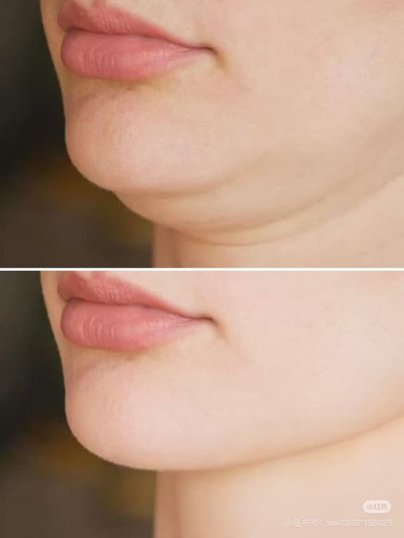 InMode 鑽石超塑腹部溶脂前後對比