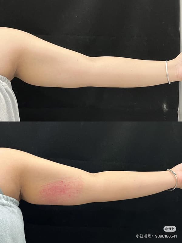 InMode 鑽石超塑腰線雕塑前後對比