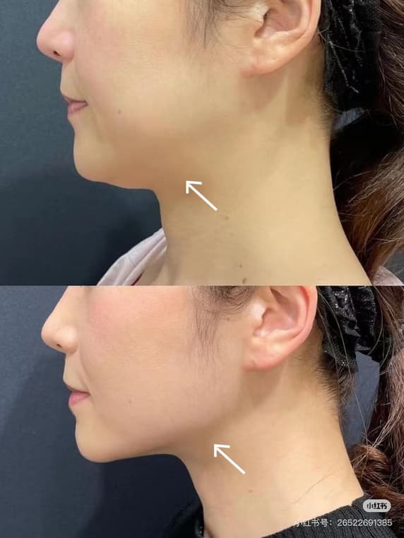 InMode 鑽石超塑手臂蝴蝶袖改善前後對比