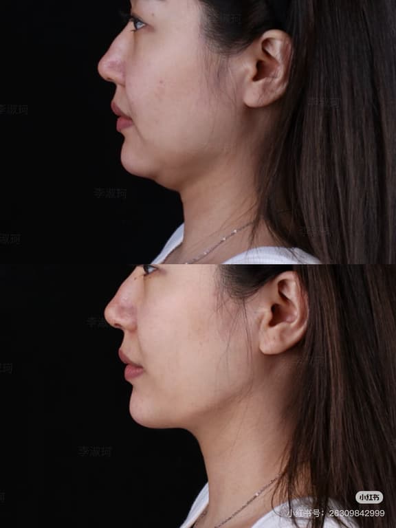 InMode 鑽石超塑臀部提拉前後對比