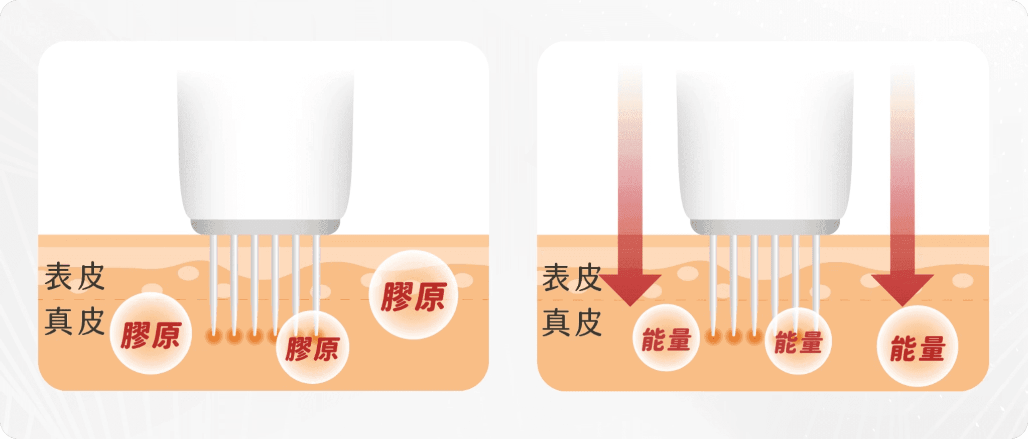 微針射頻技術原理